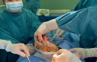 Phẫu thuật lấy búi tóc 0,5kg trong dạ dày bệnh nhi 6 tuổi