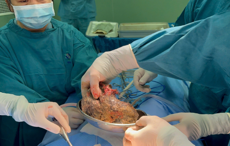 Phẫu thuật lấy búi tóc 0,5kg trong dạ dày bệnh nhi 6 tuổi