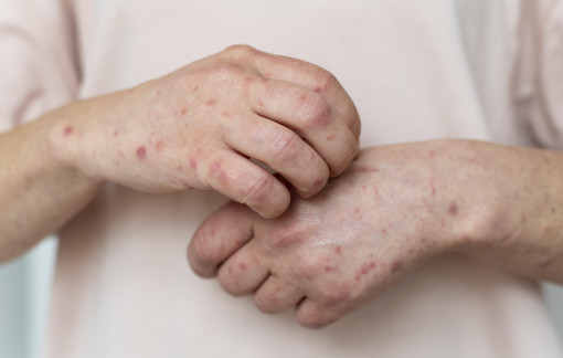 Làm sao phân biệt phát ban vì siêu vi hay do dị ứng?