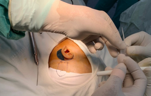 Lập “bản đồ” CT Scan giúp phẫu thuật cấy ốc tai điện tử hiệu quả