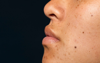 Tại sao mụn không nặn vẫn để lại vết thâm?