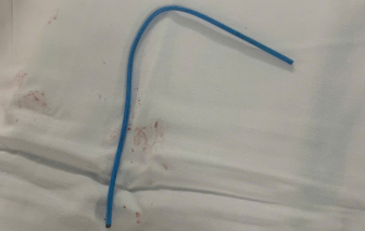 Hy hữu người phụ nữ bị ống truyền hóa chất trôi vào tim