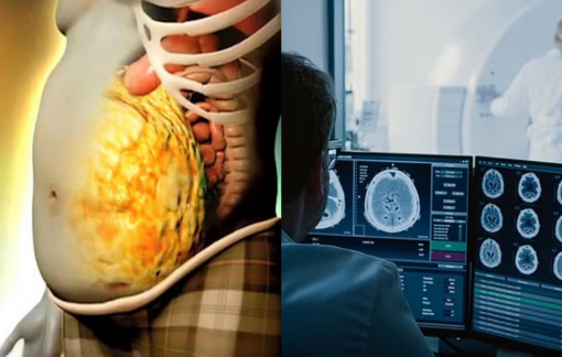 Mỡ nội tạng nhiều có thể làm tăng nguy cơ mất trí nhớ