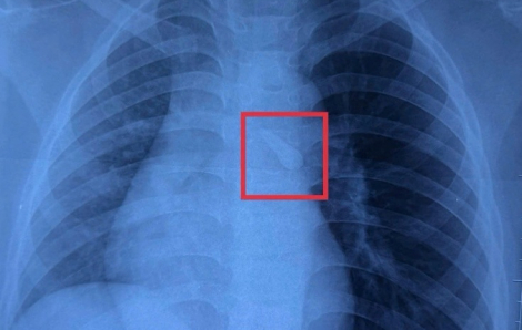 Bé trai chạy xe đạp điện tông đuôi xe tải bị hít sặc dị vật bất ngờ