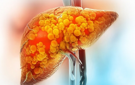 Chế độ ăn nhiều chất béo, ít tinh bột có thể làm tăng nguy cơ ung thư gan