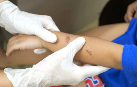 Bệnh chốc gia tăng ở trẻ, cha mẹ không nên tự ý điều trị