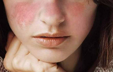 Để da không bị khô, sần sùi mùa lạnh