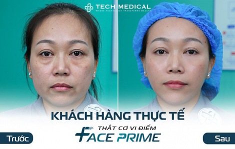Thắt cơ vi điểm khác gì với căng chỉ, phương pháp nào tốt hơn cho trẻ hóa da mặt?