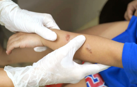 Bệnh chốc gia tăng ở trẻ, cha mẹ không nên tự ý điều trị
