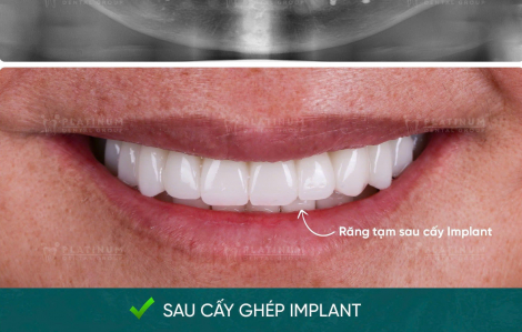 Bao lâu thì có thể ăn nhai bình thường sau khi trồng Implant toàn hàm?