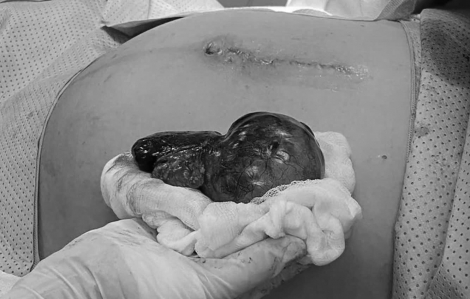 Thai phụ viêm ổ bụng, nguy kịch vì nguyên nhân ít ai nghĩ đến