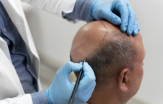 Nam giới cần biết gì trước khi quyết định cấy tóc vì hói?