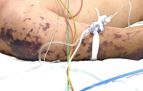 Xuất huyết khắp người sau khi ăn cỗ vì căn bệnh lầm tưởng liên cầu khuẩn