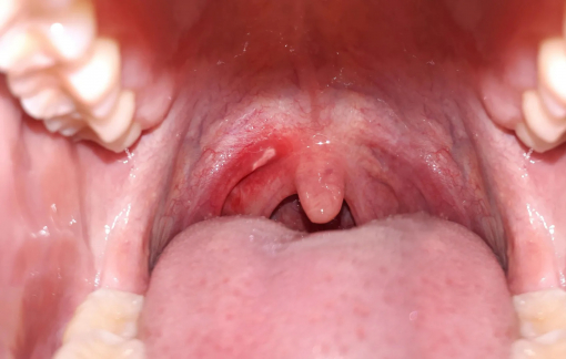 Chỉ 1 ly rượu, bia mỗi ngày cũng làm tăng nguy cơ ung thư khoang miệng