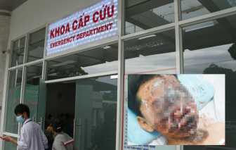 Đốt pháo, thiếu niên 13 tuổi cháy đen vùng mặt nguy cơ mù