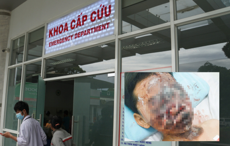 Đốt pháo, thiếu niên 13 tuổi cháy đen vùng mặt, nguy cơ mù