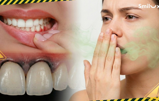 Răng sứ giá rẻ - Góc nhìn từ chất lượng và độ bền sử dụng