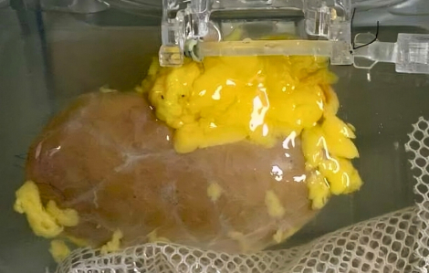 Tạo thận phổ quát có thể ghép cho mọi nhóm máu