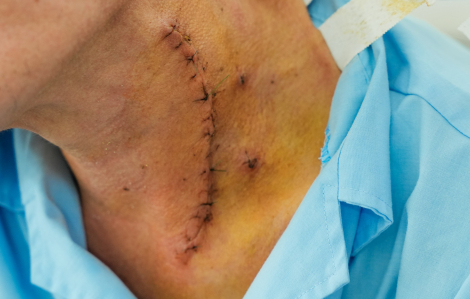 Sau khi ăn tiệc, người đàn ông phải mổ thực quản vì nguyên nhân ai cũng có thể gặp