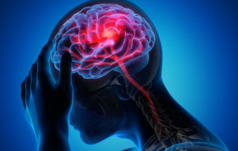 Chủ động kiểm soát nguy cơ, ngăn chặn đột quỵ não trong dịp tết