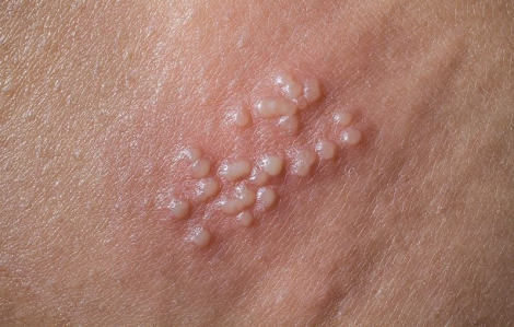 Quan hệ đồng giới, nhiều người trẻ mắc bệnh tình dục