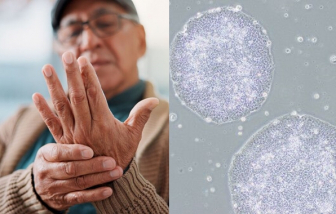 Nhật Bản phê duyệt liệu pháp tế bào gốc điều trị Parkinson