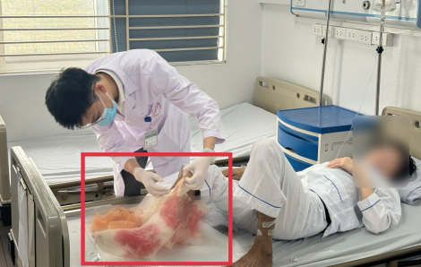 Tin mẹo dân gian chữa bỏng, người đàn ông suýt mất chân sau 1 tháng