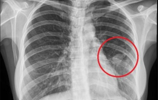 Đừng bỏ qua dấu hiệu này, gần 70% người gặp phải mắc ung thư phổi