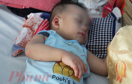 TPHCM: Số ca mắc bệnh tay chân miệng tăng nhanh