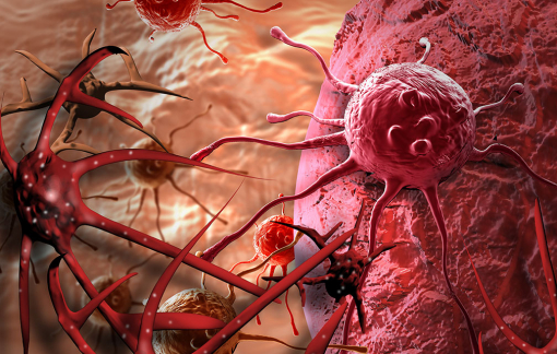 Hiếm gặp: Người đàn ông mắc cùng lúc 2 loại ung thư, không phải di căn chéo