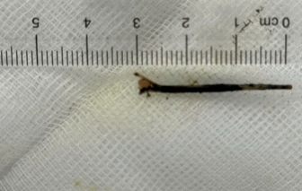 Hy hữu xương cá dài 3cm đâm xuyên vào đường mật