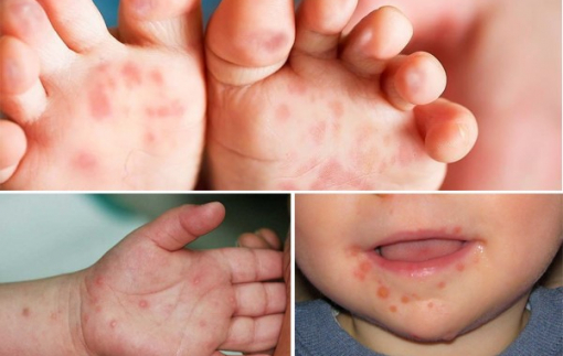 Bệnh tay chân miệng tăng mạnh ở TPHCM: Cảnh báo lầm tưởng tai hại của phụ huynh