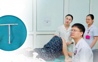 Lấy vòng tránh thai lạc chỗ sau 25 năm