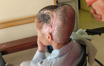 Bơm mỡ tự thân ở phòng khám tư nhân, cô gái bị nhồi máu não