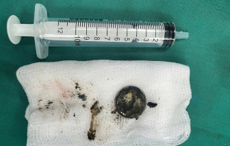 Nuốt pin cúc áo, bé 2 tuổi bị bỏng nặng thực quản