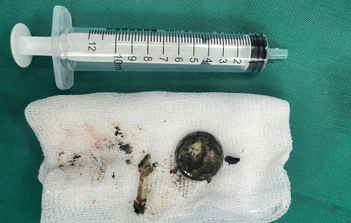 Nuốt pin cúc áo, bé 2 tuổi bị bỏng nặng thực quản