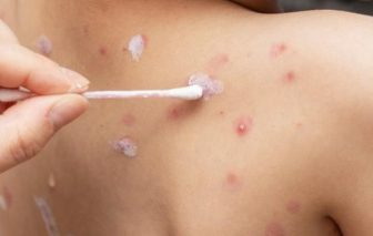 Ghi nhận ổ dịch thủy đậu tại một điểm trường tiểu học ở Đắk Lắk