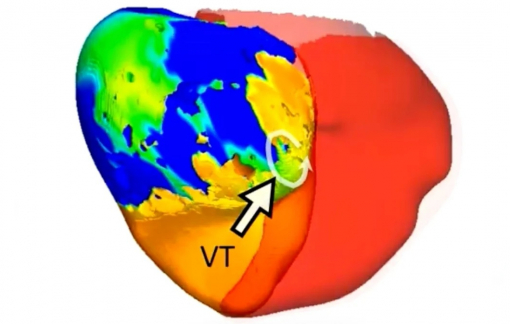 Dùng bản sao kỹ thuật số của trái tim để điều trị rối loạn nhịp tim nguy hiểm