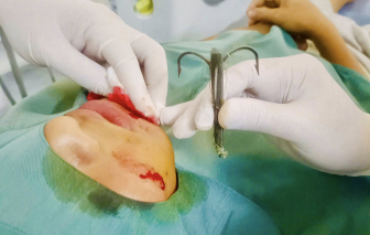 Nam sinh 15 tuổi bị lưỡi câu khủng móc vào mặt khi đi câu cá