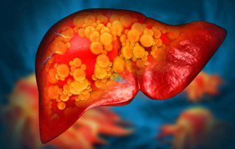 Tổn thương gan vì những lần thỉnh thoảng quá chén