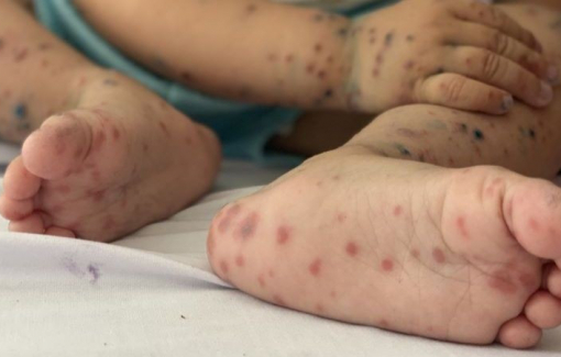 Tỉ lệ mắc bệnh tay chân miệng tăng gấp 1,5 lần, Đà Nẵng khẩn trương kiểm soát