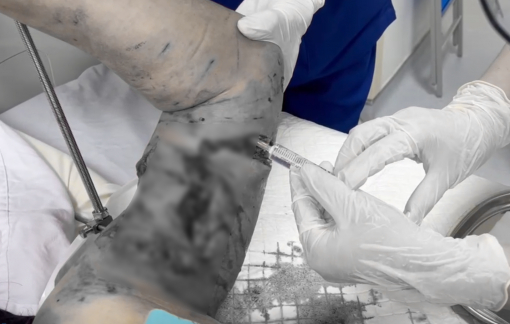 Chó becgie nhà nuôi 'trở tính' sau ốm, cắn nát tay cụ bà