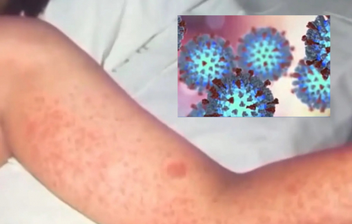 Dịch sởi lan rộng tại Mỹ, bang có nhiều người Việt nhất có thể thành ổ dịch