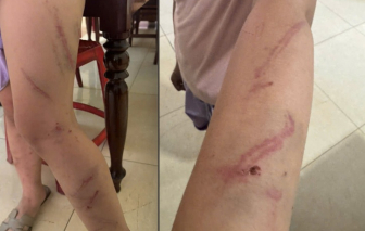 Người cha đưa con gái có nhiều vết bầm trên cơ thể đến công an trình báo