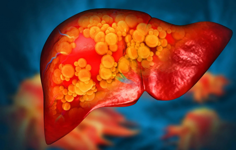 Tổn thương gan vì những lần thỉnh thoảng quá chén