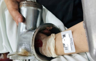 Người phụ nữ bị máy xay thịt 'nuốt' bàn tay