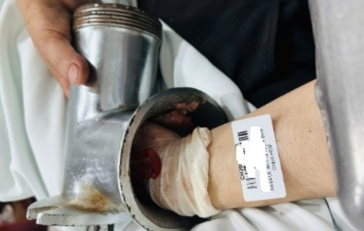 Người phụ nữ bị máy xay thịt 'nuốt' bàn tay