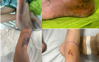 Bị rắn độc cắn khi đang cho ăn, chủ trang trại suýt trả giá đắt