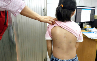 Nắng nóng, chó mèo trở nên hung hãn tấn công người