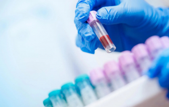 Xét nghiệm máu giúp dự báo bệnh Alzheimer sớm nhiều năm